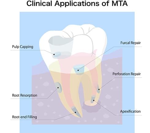 MTAセメント