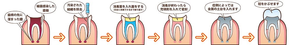 精度の高い根管治療