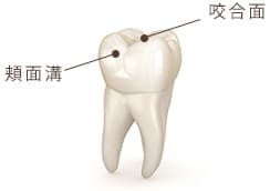 3.奥歯の溝が深い