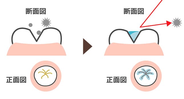 小窩裂溝予防填塞（シーラント）