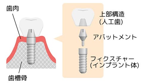 インプラントの構造