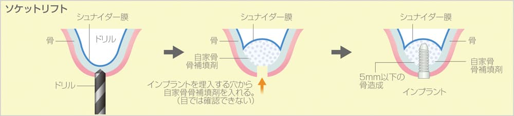 ソケットリフト