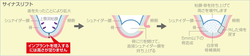 サイナスリフト