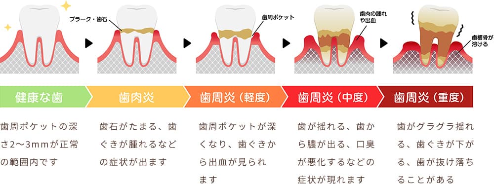 歯周病のステージ